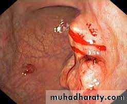 Esoph and gastric tumor