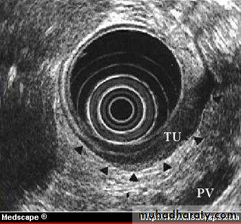 Esoph and gastric tumor