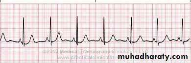 Heart failure