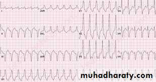 Heart failure