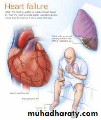 Heart failure