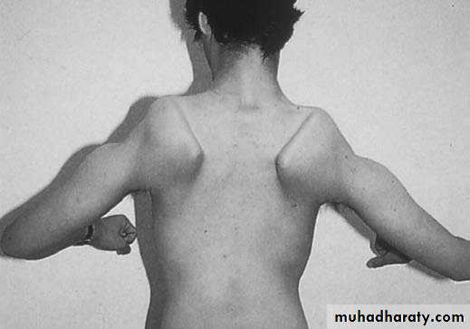 muscular dystrophy ppt