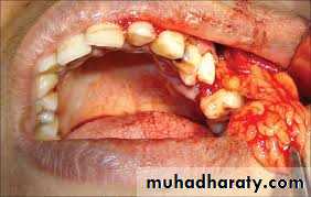 Parotid gland
