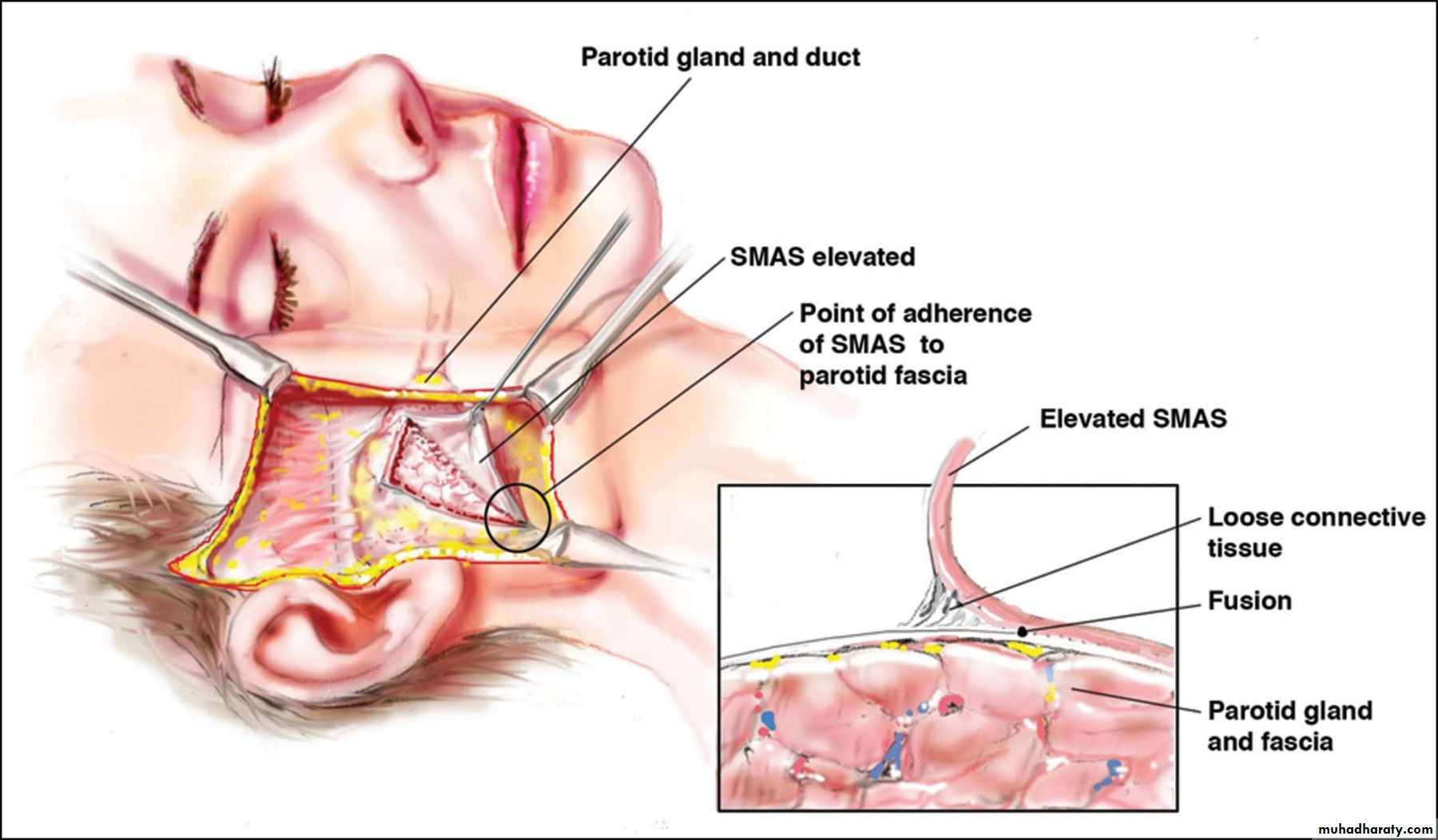 Parotid gland