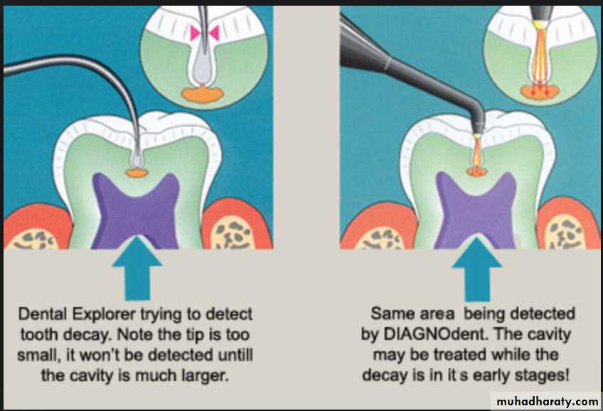 caries diagnosis