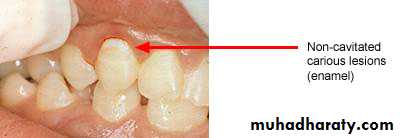 caries diagnosis