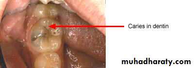 caries diagnosis
