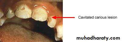 caries diagnosis