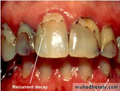 caries diagnosis