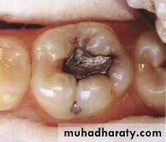 caries diagnosis