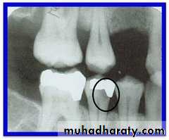 caries diagnosis