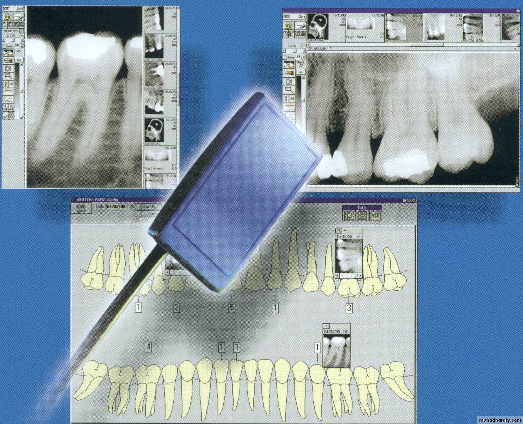 caries diagnosis