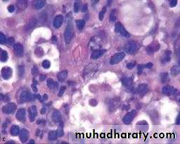 periapical pathology