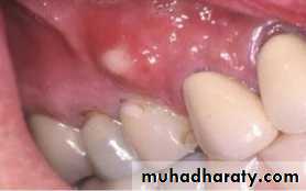 periapical pathology