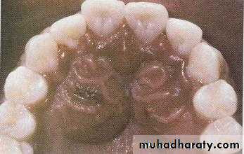 periapical pathology
