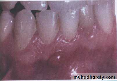 periapical pathology