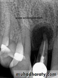 periapical pathology
