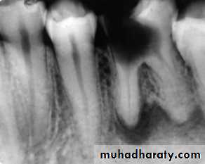 periapical pathology