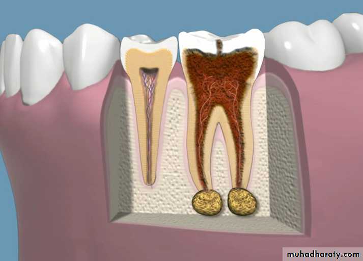 periapical pathology