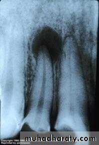 periapical pathology