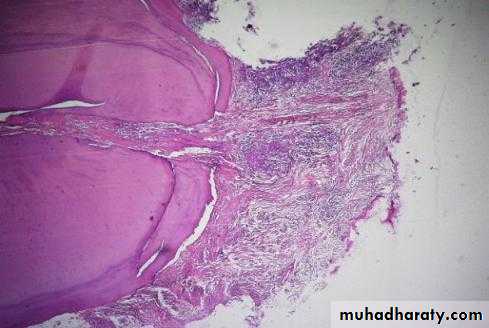 periapical pathology