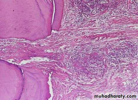periapical pathology
