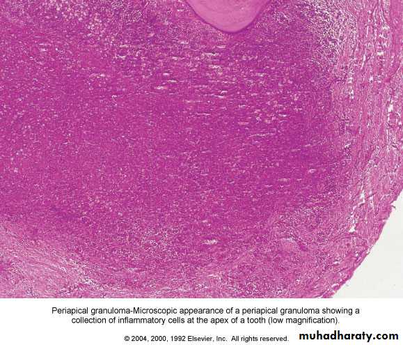 periapical pathology