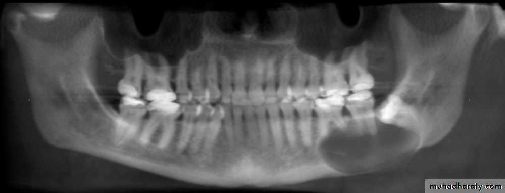 periapical pathology