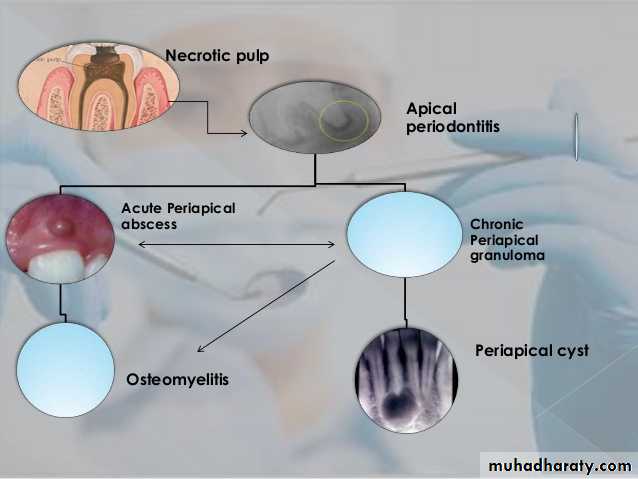 periapical pathology
