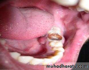 periapical pathology
