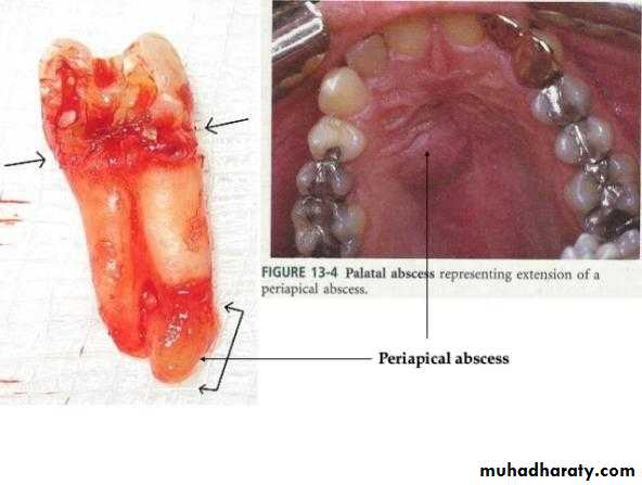 periapical pathology