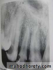 periapical pathology