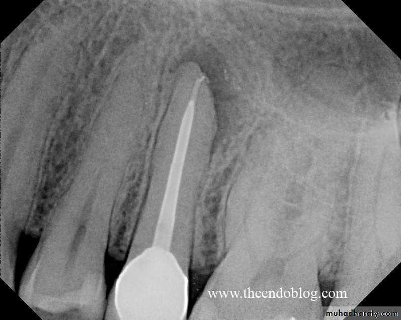 periapical pathology