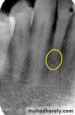 periapical pathology
