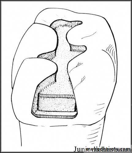 Class II Cavity Preparation