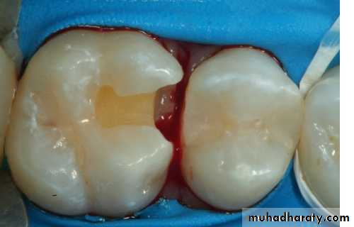 Class II Cavity Preparation