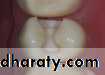 Class II Cavity Preparation