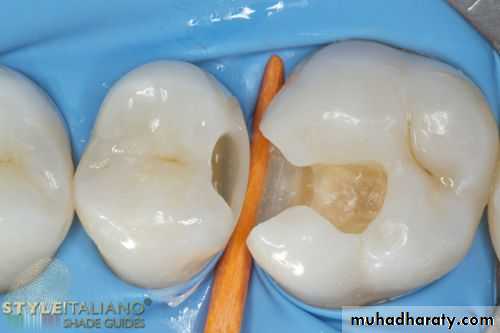 Class II Cavity Preparation