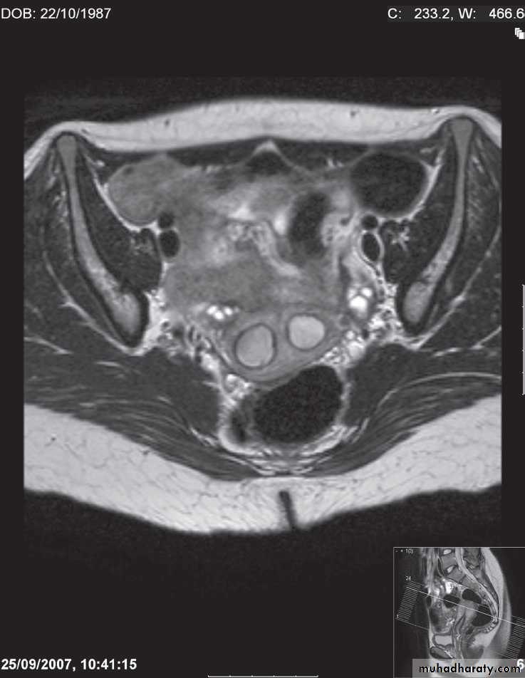 female genital tract 1 ppt