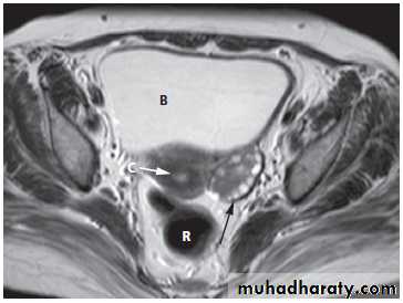 female genital tract 1 ppt