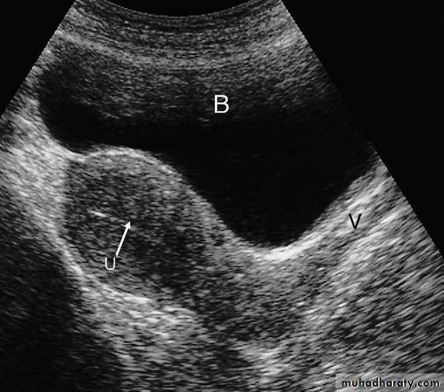 female genital tract 1 ppt
