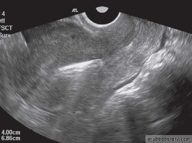 female genital tract 2 ppt