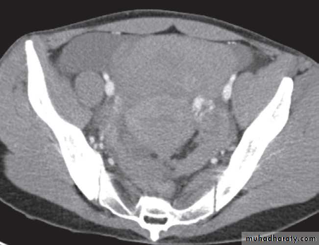 female genital tract 2 ppt