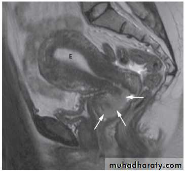 female genital tract 2 ppt