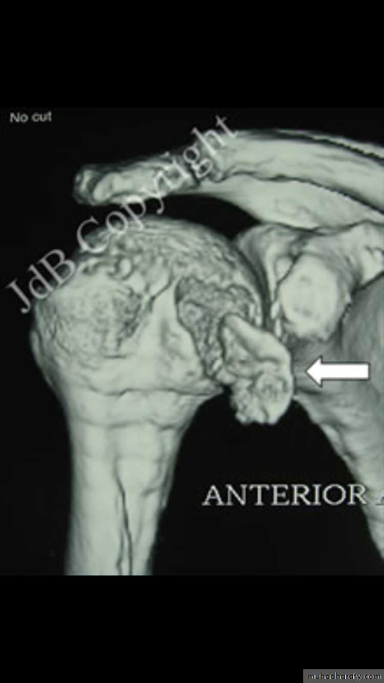 neer classification