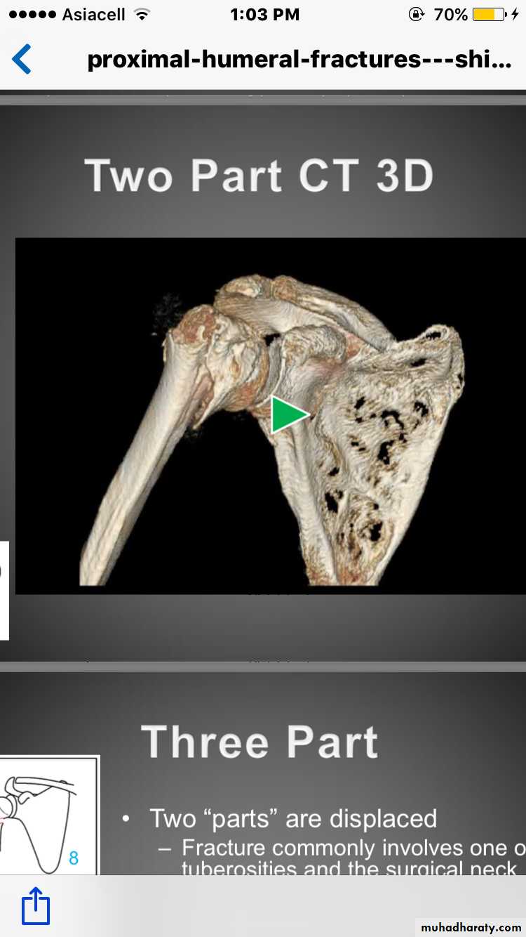 neer classification