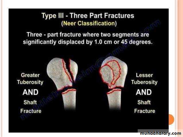 neer classification