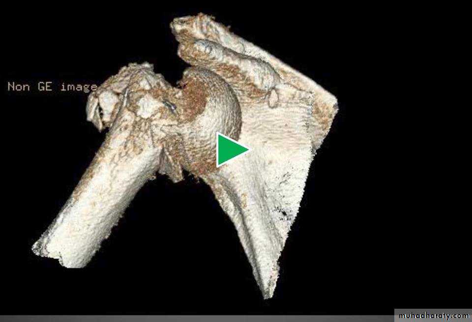 neer classification