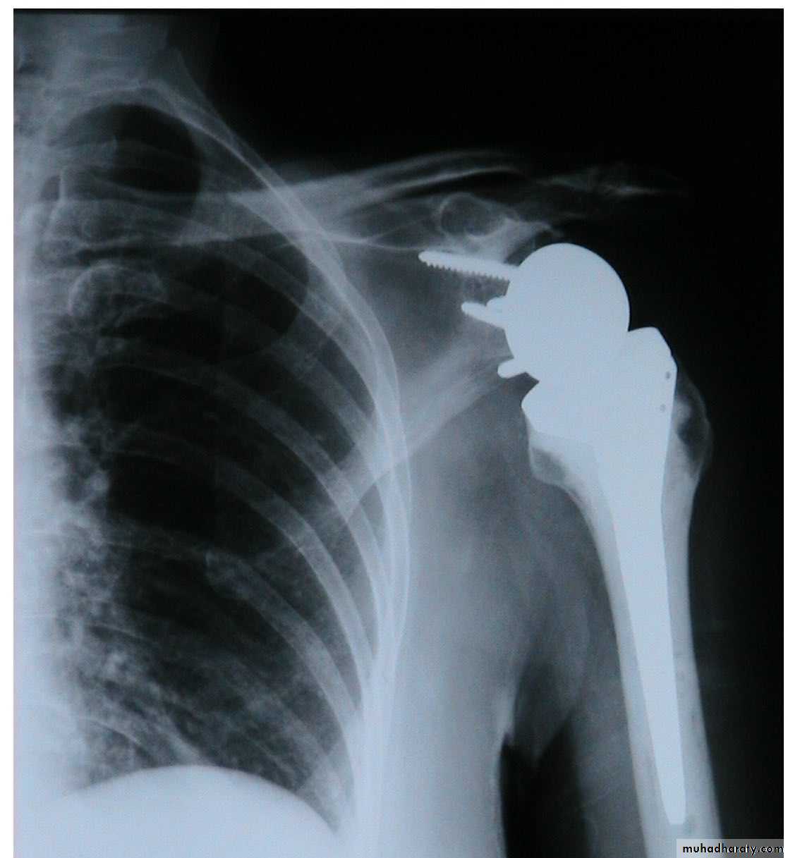 neer classification
