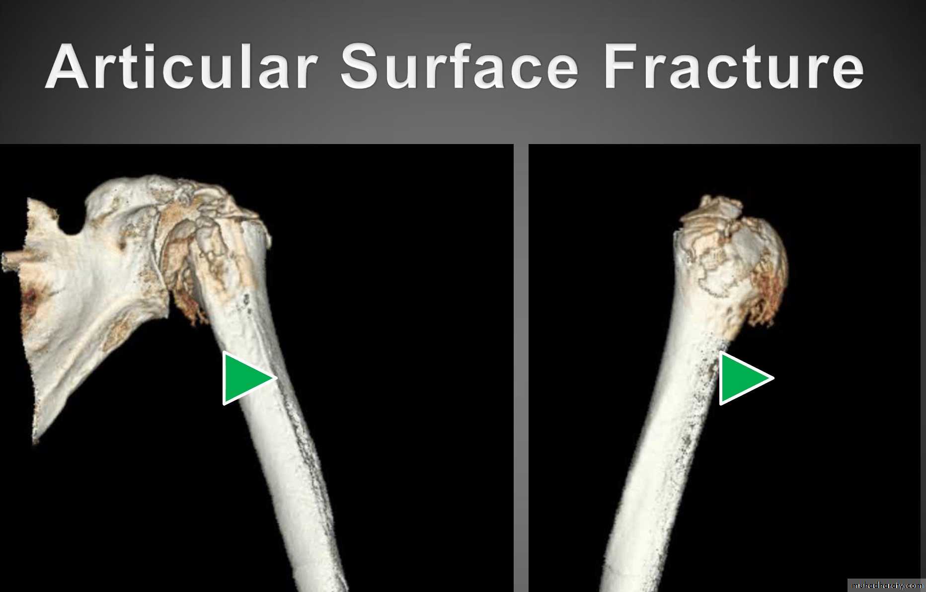 neer classification